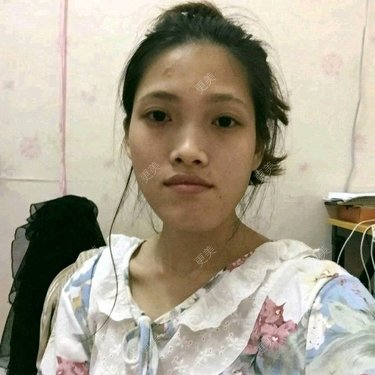 面部不对称矫正