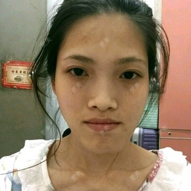 面部不对称矫正