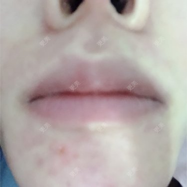 鼻部硅胶假体取出