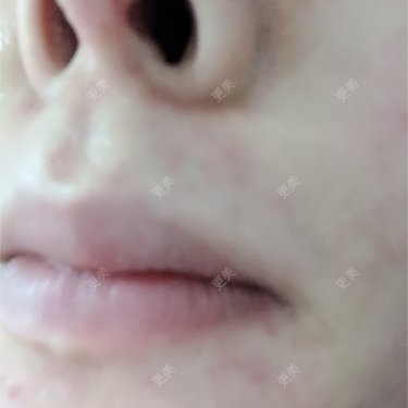 鼻部硅胶假体取出