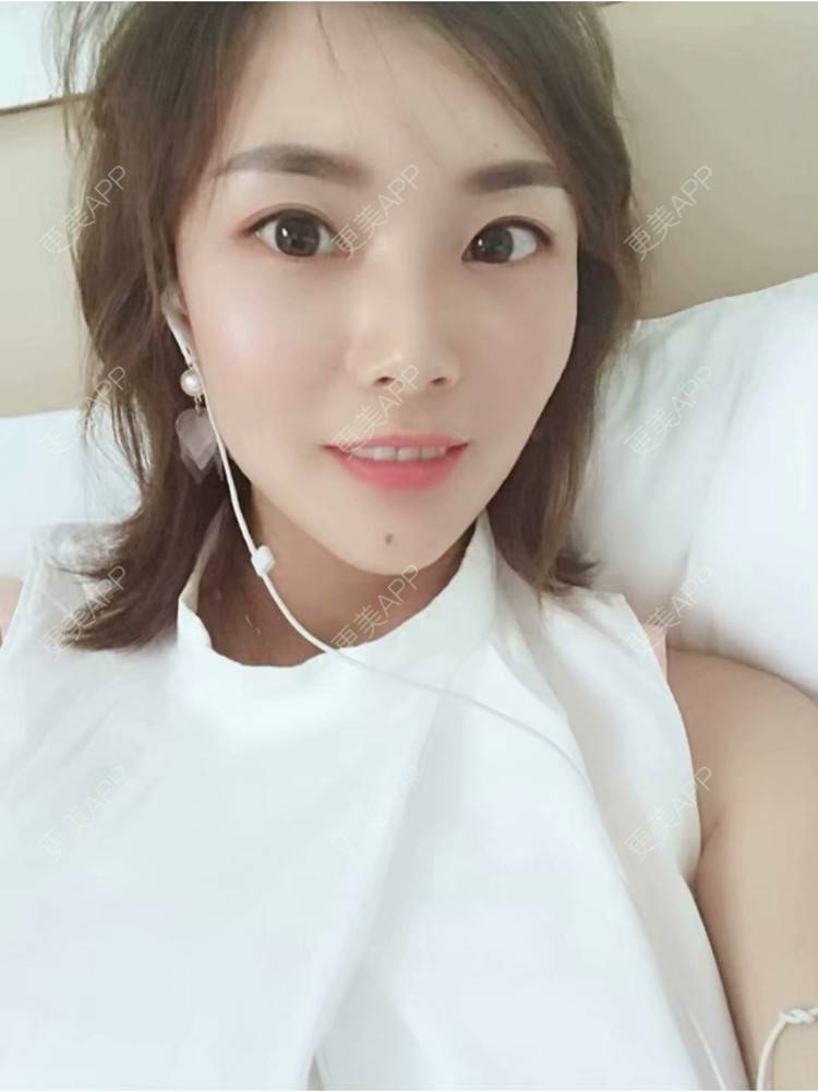 更美 - 丽丽18508552535的内切去眼袋经验 | 内切去眼袋 | 武汉
