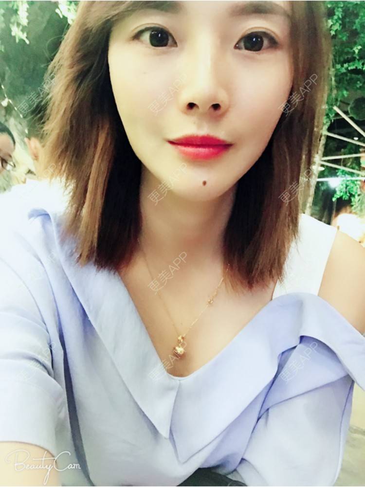 更美 - 丽丽18508552535的内切去眼袋经验 | 内切去眼袋 | 武汉