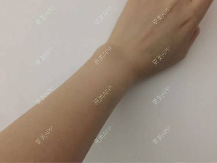 更美 - 更美用户9JT5WldOIY的手臂脱毛经验 | 手臂脱毛 | 深圳