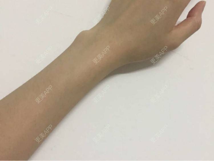 更美 - 更美用户9JT5WldOIY的手臂脱毛经验 | 手臂脱毛 | 深圳