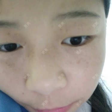 淡斑套餐