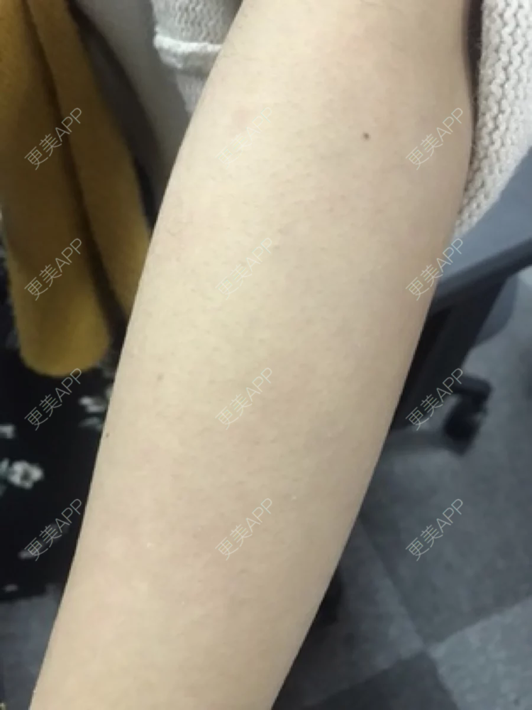 更美 - 更美用户UkeThzuZRr的手臂脱毛经验 | 深圳 | 手臂脱毛