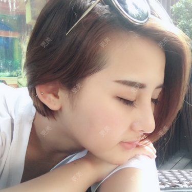 自体脂肪丰面颊
