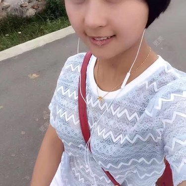 自体脂肪丰面颊