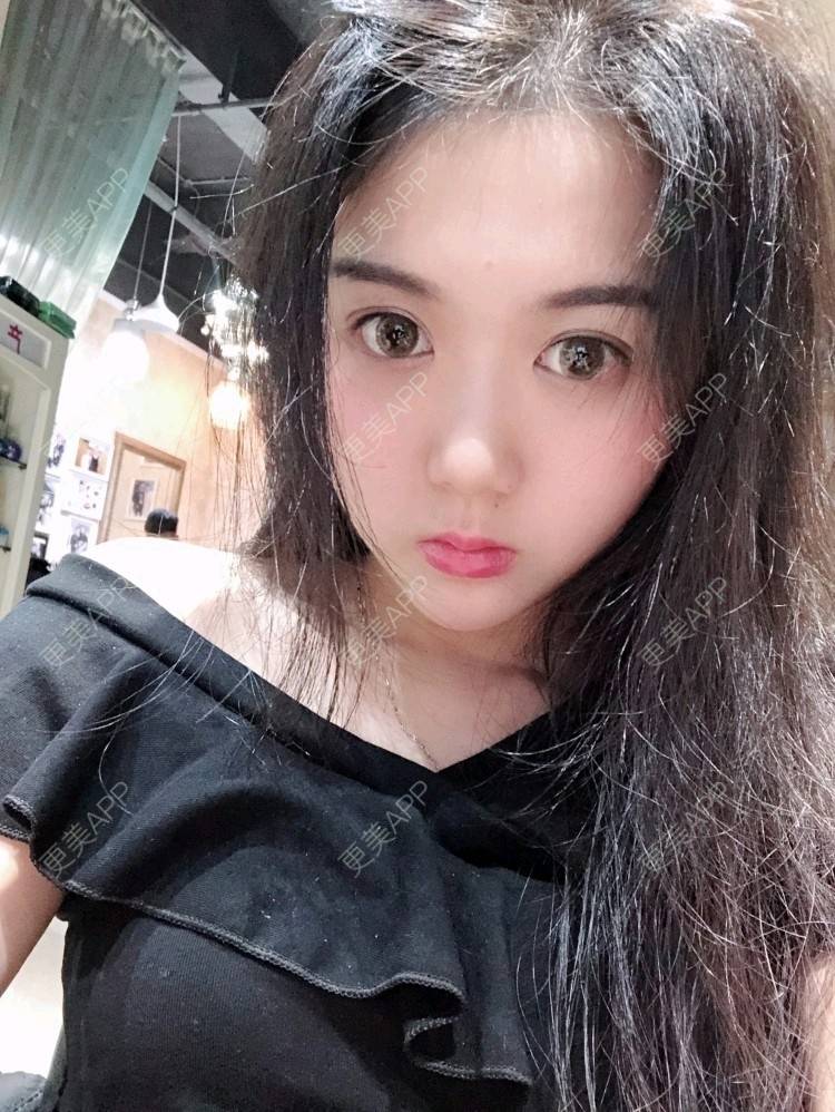 更美 - 更美用户sGj1i20LB6的下巴经验 | 自体脂肪全面部填充 | 西安 | 青岛 | 补水套餐 | 水光项目 | 下巴 | 双眼皮 | 上海 | 假体隆胸 | 隆鼻 | 武汉 | 广州 | 贵阳 | 吸脂 | 哈尔滨