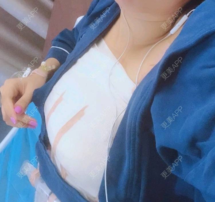 更美用户r7i2zmgulu的假体隆胸日记