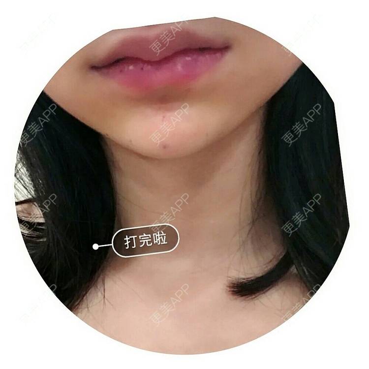 更美 - 更美用户Y2x3MABGwW的玻尿酸唇部经验 | 玻尿酸唇部 | 成都