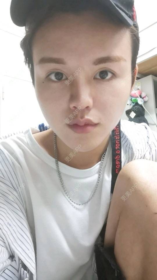 更美 - 更美用户吕祥的鼻部多项经验 | 隆胸 | 光子脱毛 | 光子嫩肤 | 瘦脸除皱 | 假体隆胸 | 鼻部综合 | 鼻部多项 | 皮秒激光 | 硅胶垫下巴 | 武汉