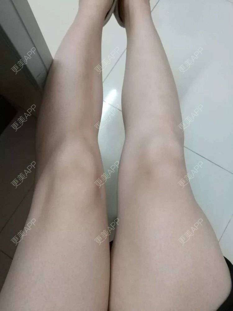 更美 - 扎心了老姐的大腿脱毛经验 | 大腿脱毛 | 深圳