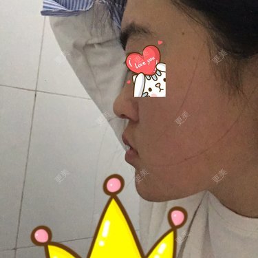 轮廓修复