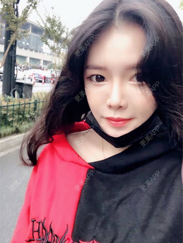 更美 - yuki666的玻尿酸经验 | 深圳 | 像素激光 | 鼻部综合 | 胸部修复 | 杭州 | 武汉 | 玻尿酸