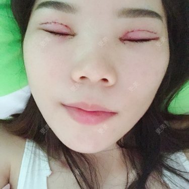 眼部多项