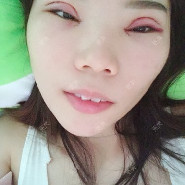 眼部多项