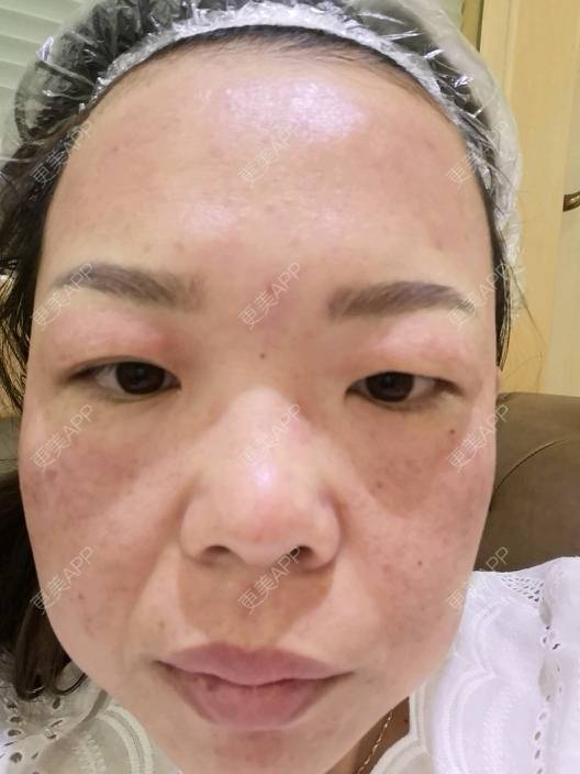 更美 - p&no的皮秒激光经验 | 上海 | 武汉 | 牙齿矫正 | 埋线隆鼻 | 皮秒激光 | 合肥