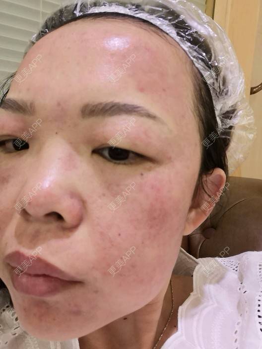 更美 - p&no的皮秒激光经验 | 上海 | 武汉 | 牙齿矫正 | 埋线隆鼻 | 皮秒激光 | 合肥