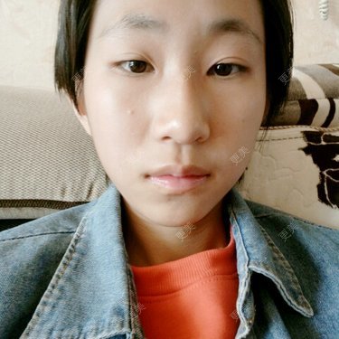 宽下巴矫正