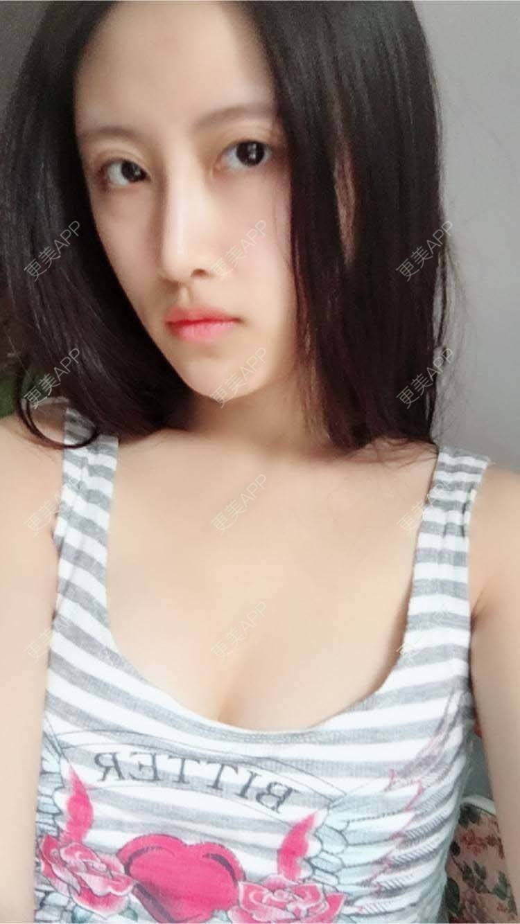 更美用户5phqzikzty的自体脂肪隆胸日记