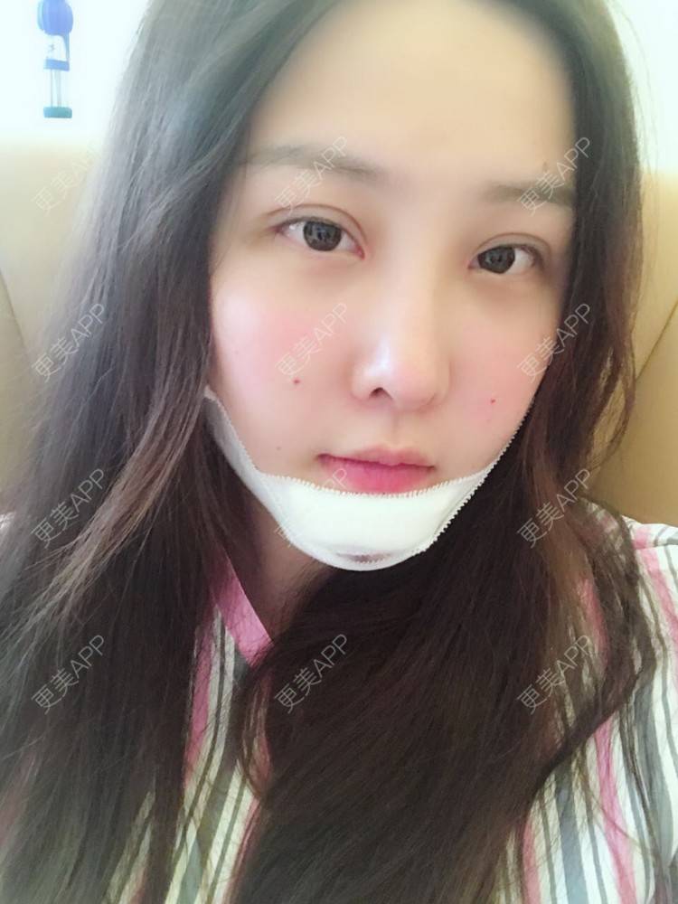 更美 - 如果你知道我知道的硅胶垫下巴经验 | 硅胶垫下巴 | 南宁