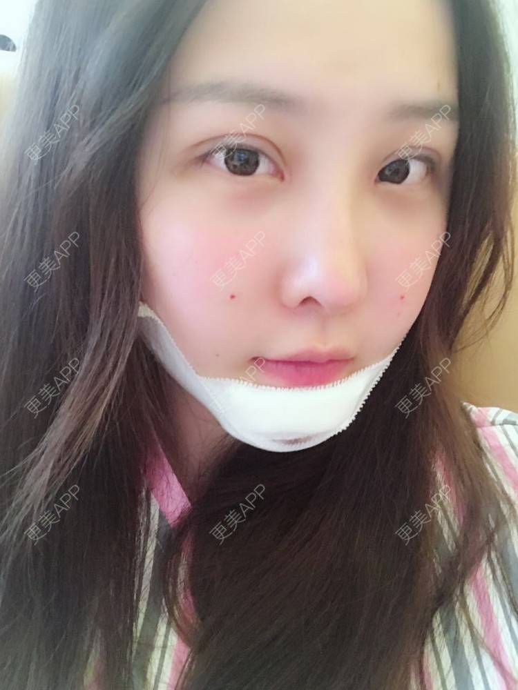 更美 - 如果你知道我知道的硅胶垫下巴经验 | 硅胶垫下巴 | 南宁