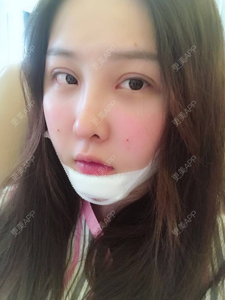 更美 - 如果你知道我知道的硅胶垫下巴经验 | 硅胶垫下巴 | 南宁