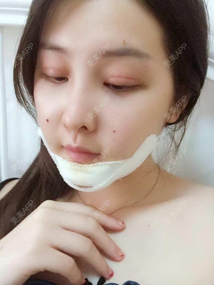 更美 - 如果你知道我知道的硅胶垫下巴经验 | 硅胶垫下巴 | 南宁