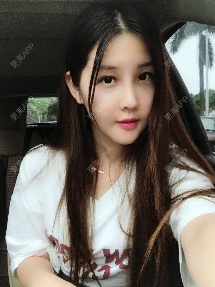 更美 - 如果你知道我知道的硅胶垫下巴经验 | 自体脂肪丰苹果肌 | 硅胶垫下巴 | 南宁