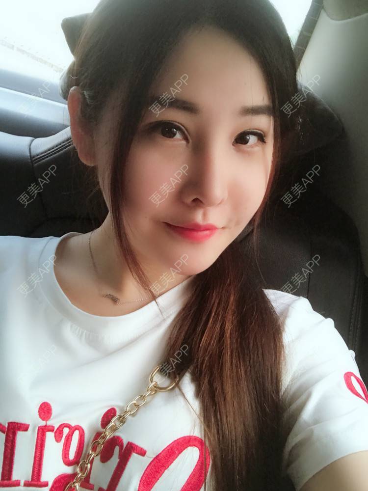 更美 - 如果你知道我知道的硅胶垫下巴经验 | 自体脂肪丰苹果肌 | 硅胶垫下巴 | 南宁