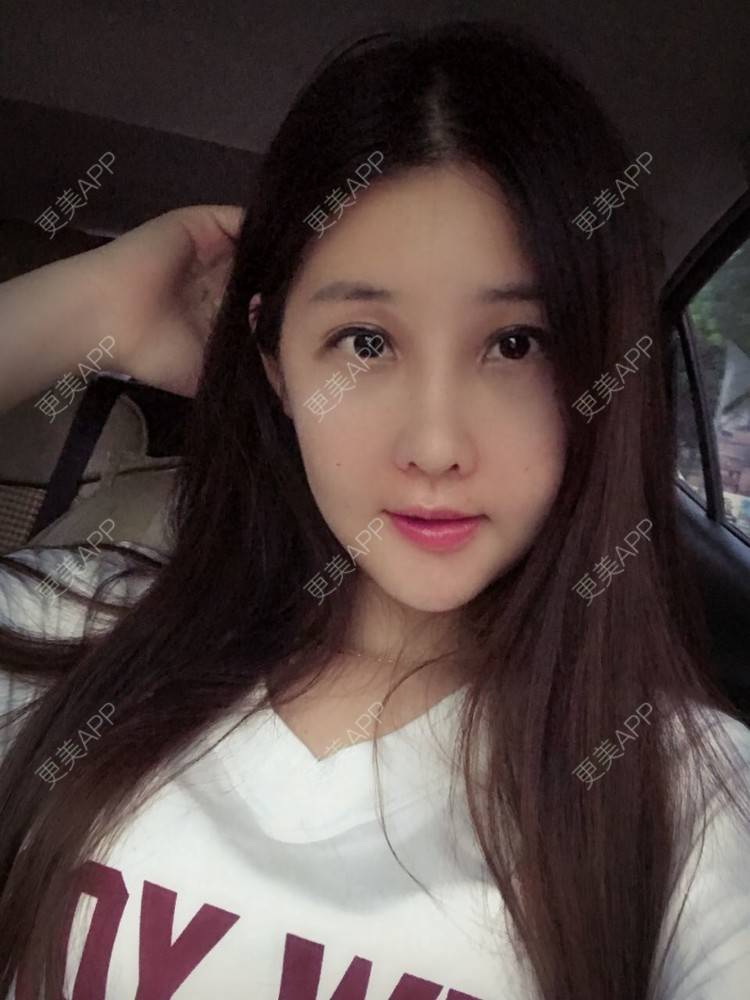 更美 - 如果你知道我知道的硅胶垫下巴经验 | 自体脂肪丰苹果肌 | 硅胶垫下巴 | 南宁