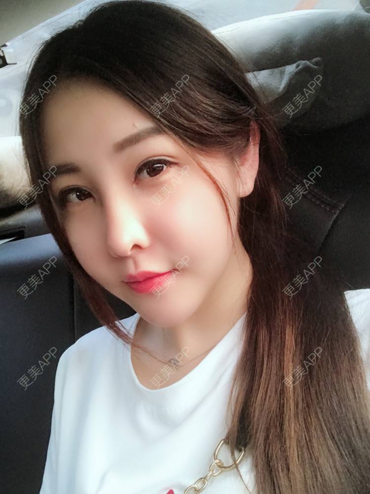 更美 - 如果你知道我知道的硅胶垫下巴经验 | 自体脂肪丰苹果肌 | 硅胶垫下巴 | 南宁