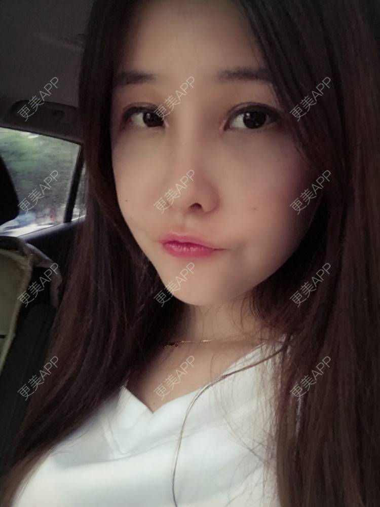 更美 - 如果你知道我知道的硅胶垫下巴经验 | 自体脂肪丰苹果肌 | 硅胶垫下巴 | 南宁