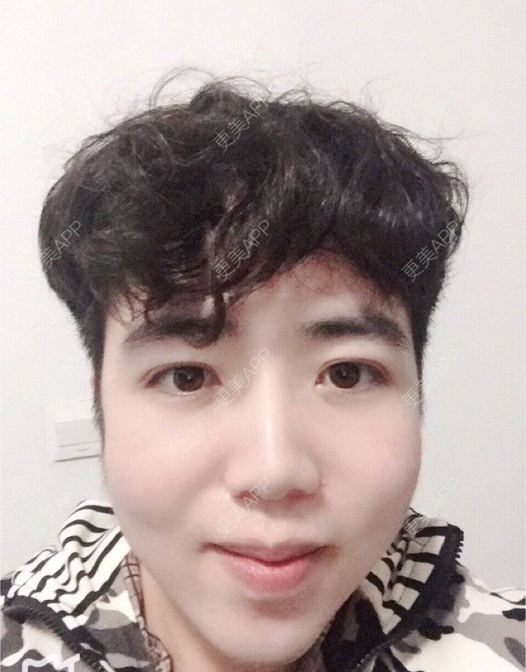 更美 - 叮当猫的时光机的硅胶垫下巴经验 | 杭州 | 硅胶垫下巴