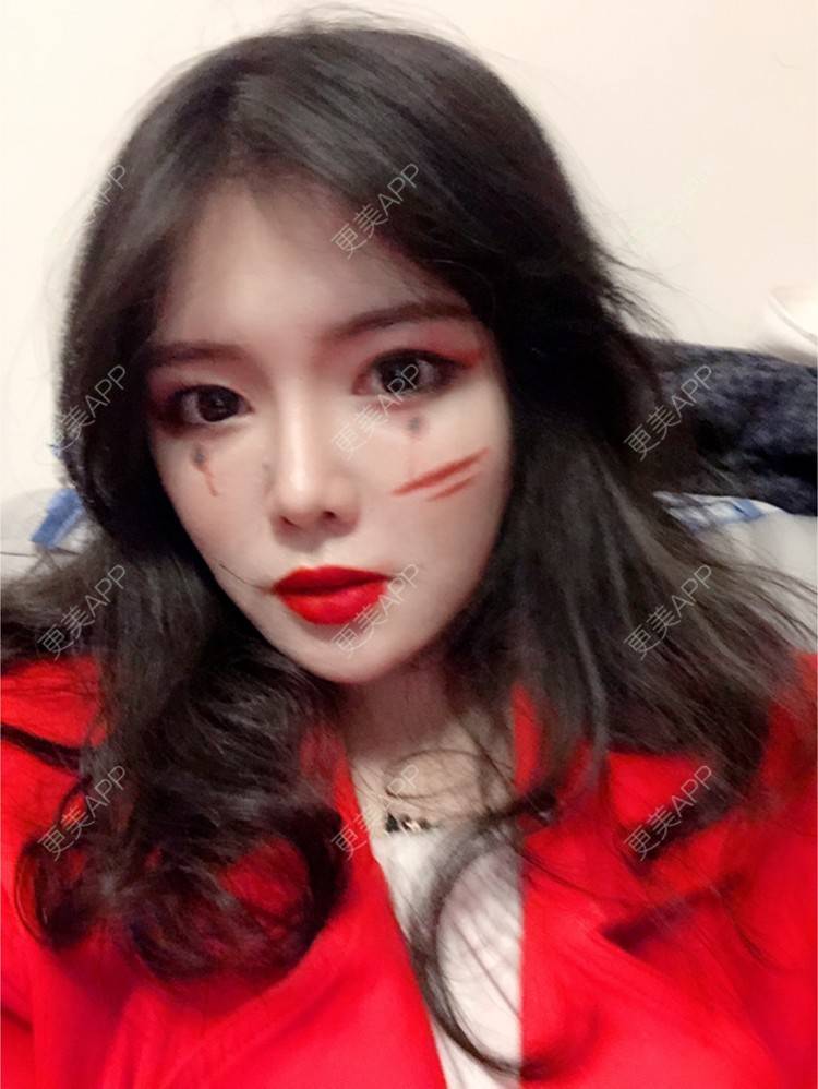 更美 - yuki666的玻尿酸经验 | 深圳 | 像素激光 | 鼻部综合 | 胸部修复 | 杭州 | 武汉 | 玻尿酸