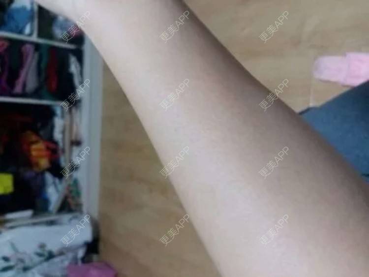 更美 - 神奇女侠C的手臂脱毛经验 | 手臂脱毛 | 深圳