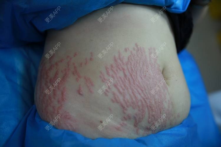 红尘若梦牵魂的妊娠纹日记