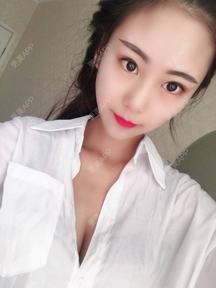 更美用户nbu058vkjd的自体脂肪隆胸日记