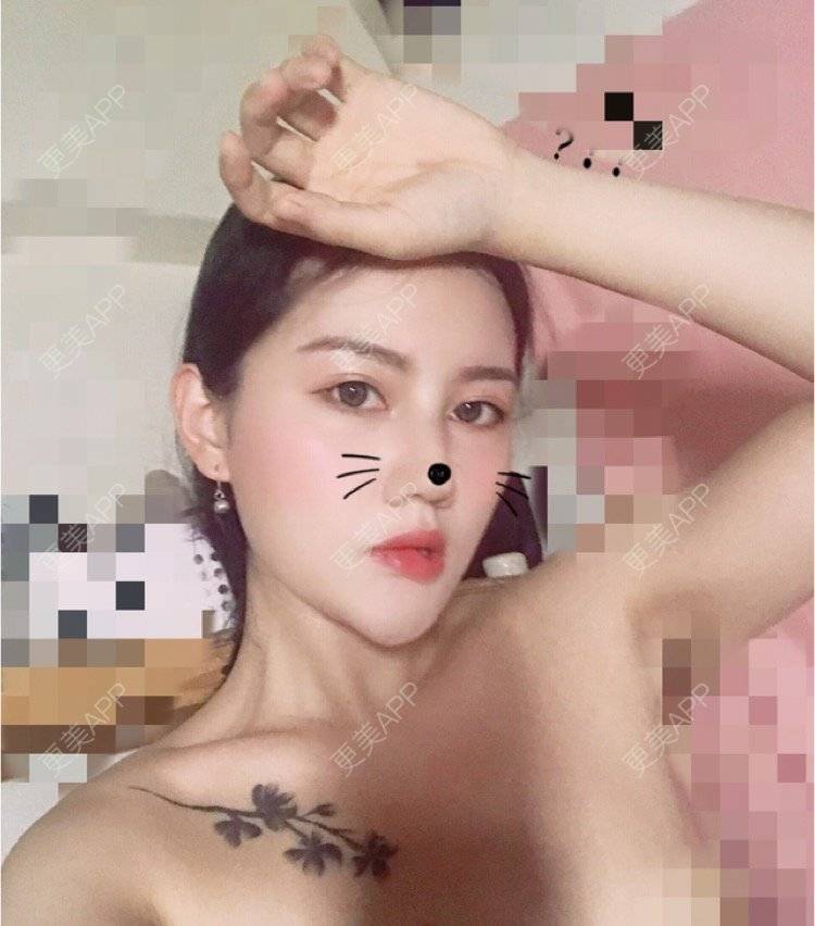 更美 - Kaleidoscope.的隆鼻经验 | 咸阳 | 隆鼻