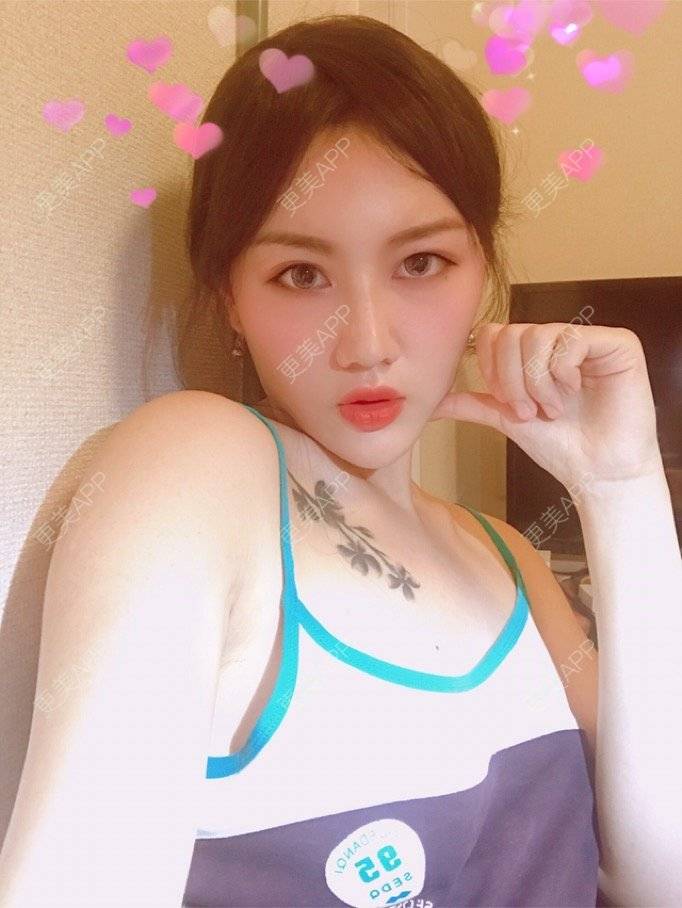 更美 - Kaleidoscope.的隆鼻经验 | 咸阳 | 隆鼻