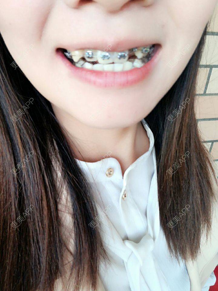 更美用户fl7nwuaywx的牙齿矫正日记