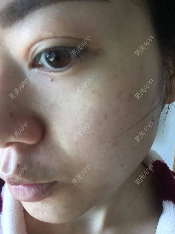 圈圈圆圆00的激光淡斑日记