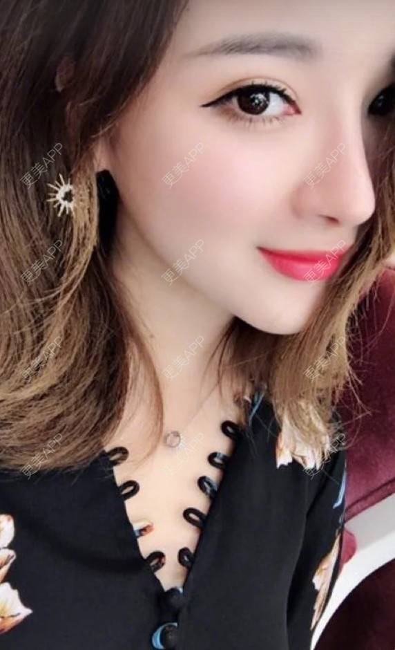 更美 - 犯二姑娘的埋线提升经验 | 长沙 | 祛斑祛色素 | 吸脂瘦脸 | 北京 | 杭州 | 皮肤综合管理套餐 | 注射塑形腿部 | 大连 | 祛眼袋 | 西安 | 除皱瘦脸 | 武汉 | 埋线提升 | 南昌 | 深圳