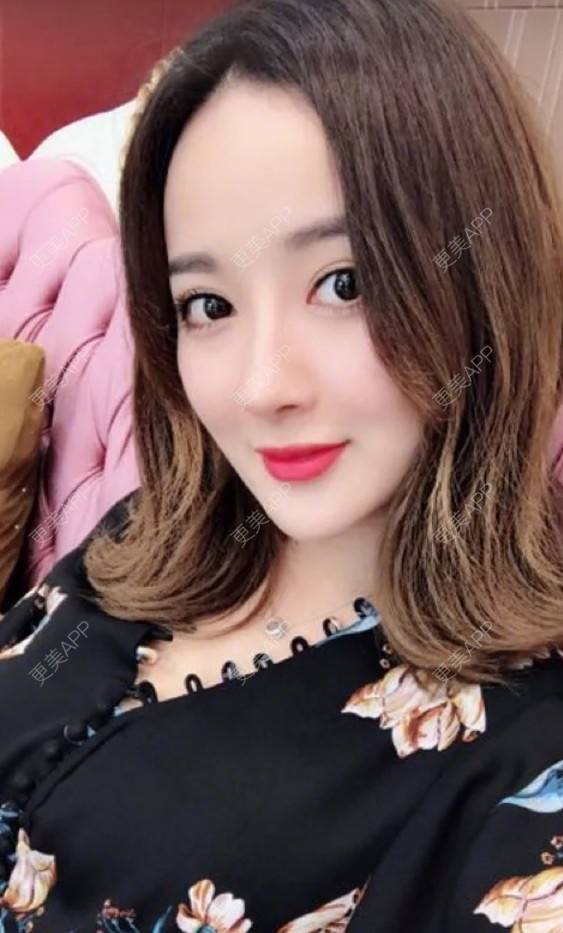 更美 - 犯二姑娘的埋线提升经验 | 长沙 | 祛斑祛色素 | 吸脂瘦脸 | 北京 | 杭州 | 皮肤综合管理套餐 | 注射塑形腿部 | 大连 | 祛眼袋 | 西安 | 除皱瘦脸 | 武汉 | 埋线提升 | 南昌 | 深圳