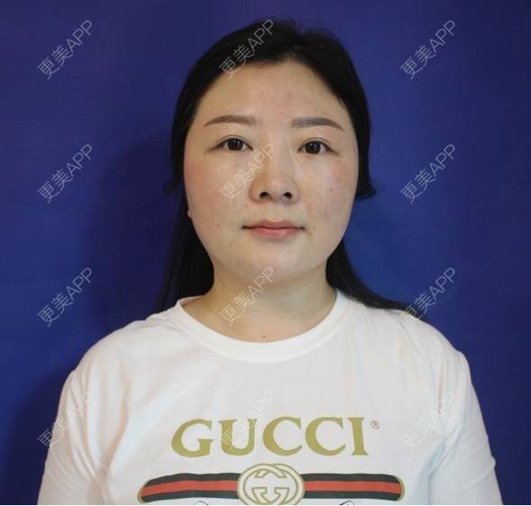 更美 - 更美用户6DhZGpqnCz的鼻部综合经验 | 眼部修复 | 丰胸（隆胸） | 鼻部多项 | 酒窝成形 | 水光项目 | 双眼皮 | 祛斑祛色素 | 隆鼻 | 彩光嫩肤 | 牙齿美白 | 洗牙 | 牙贴面 | 玻尿酸 | 自体脂肪隆胸 | 肋软骨隆鼻 | 吸脂 | 瘦脸除皱 | 小气泡 | 激光淡化红血丝 | 女性私密 | 鼻部综合 | 武汉