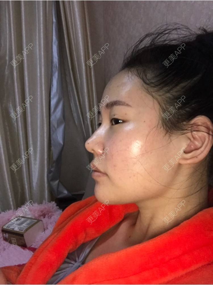 更美 - 18*******27的玻尿酸经验 | 眼部修复 | 眼部综合 | 北京 | 美白套餐 | 皮肤综合管理套餐 | 双眼皮 | 上海 | 祛眼袋 | 西安 | 武汉 | 长沙 | 广州 | 南昌 | 深圳 | 玻尿酸 | 祛斑祛色素 | 激光脱毛 | 杭州 | 注射塑形腿部 | 下巴 | 大连 | 除皱瘦脸 | 吸脂瘦脸 | 埋线提升