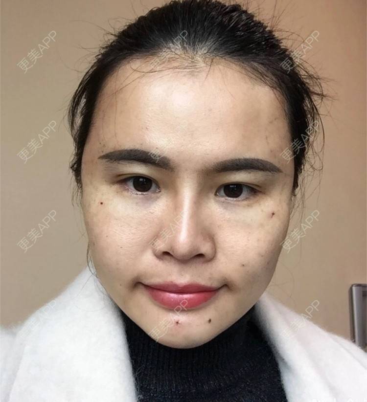 刘凤梅的自体脂肪填充面部日记