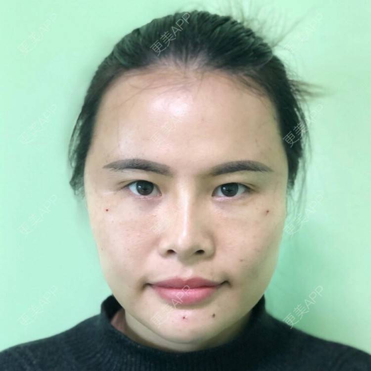 刘凤梅的自体脂肪填充面部日记