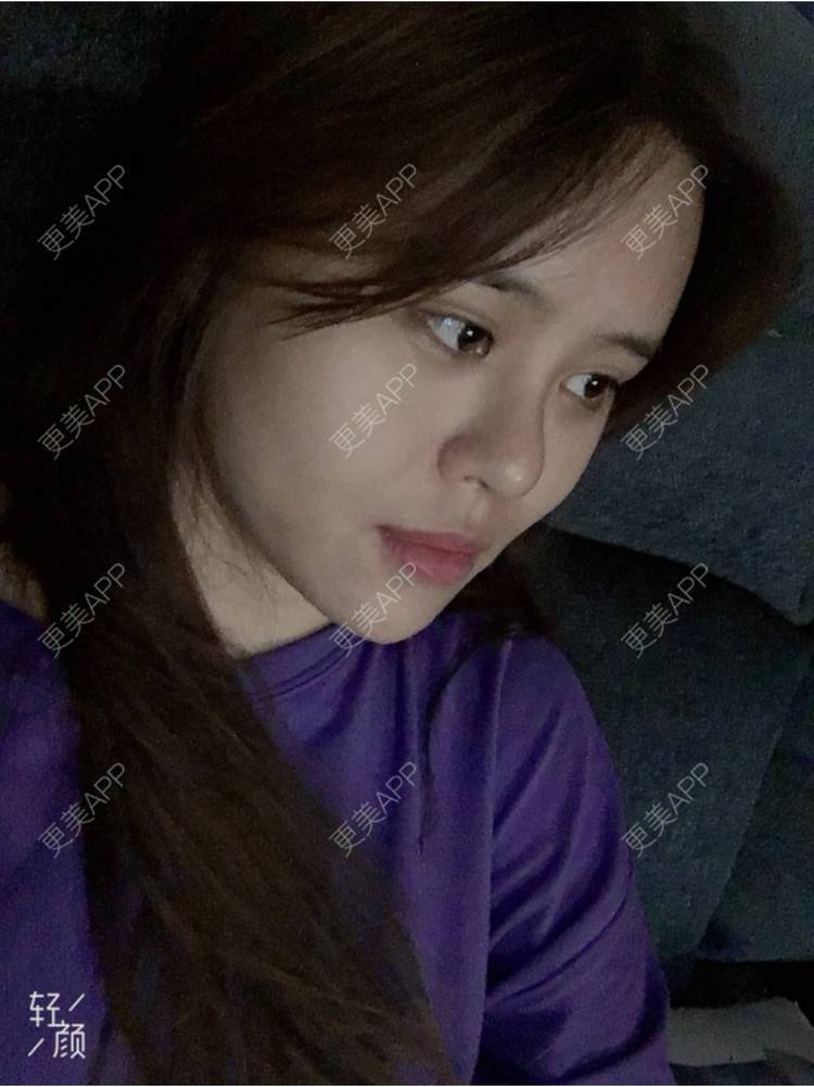 更美 - xin💕的经验 | 膨体隆鼻 | 郑州